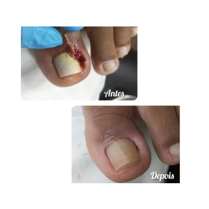 Onicocriptose  c/ infecção é s/infecção 