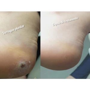 Tratamento verrugas plantar (olho de peixe)