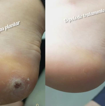 Imagem Tratamento verrugas plantar (olho de peixe)