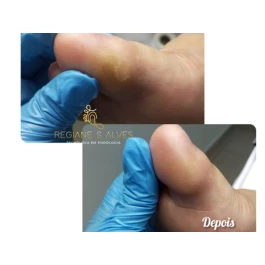 Calos, calosidade, hiperqueratose e queratose