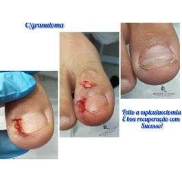 Unha encravada onicocriptose infeccionada 