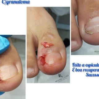 Unha encravada onicocriptose infeccionada 