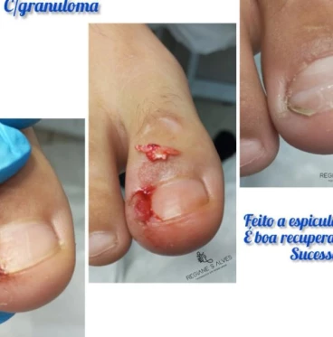 Imagem Unha encravada onicocriptose infeccionada 