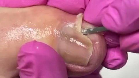 Procedimento de onicrocriptose s/infecção 