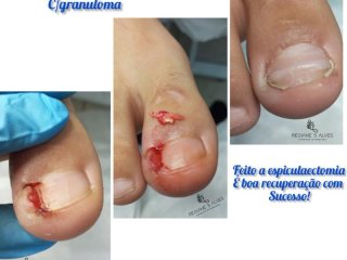 Unha encravada onicocriptose infeccionada 