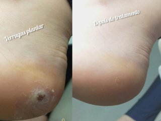 Tratamento verrugas plantar (olho de peixe)